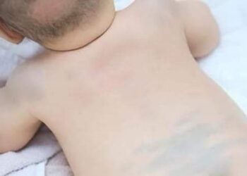 البقعة المنغولية في الاطفال (mongolian spots)